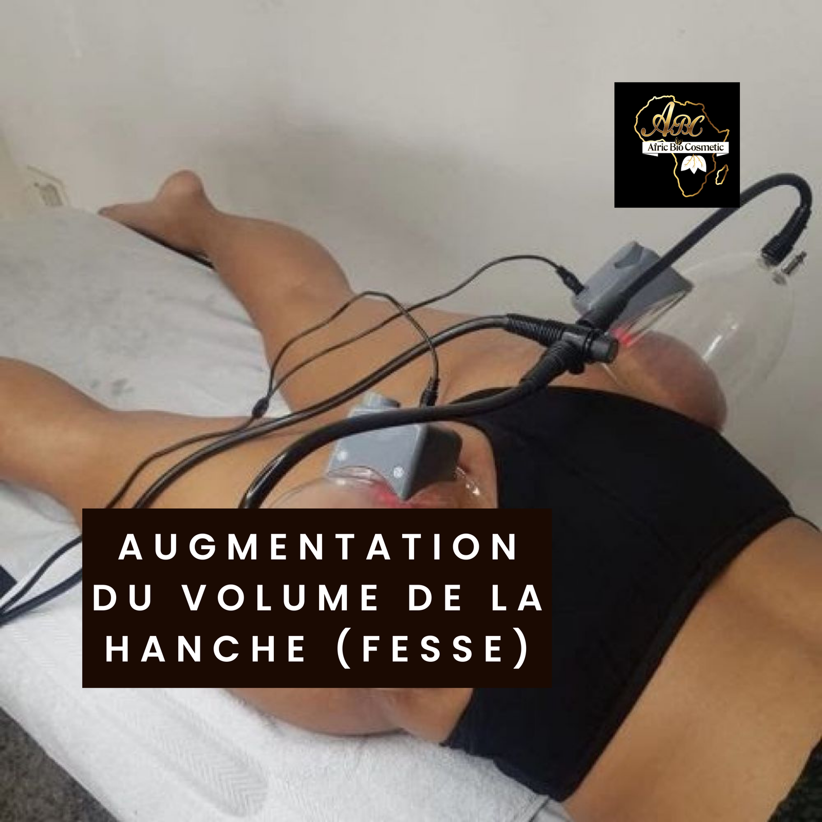 augmentation du volume de la hanche (fesse)