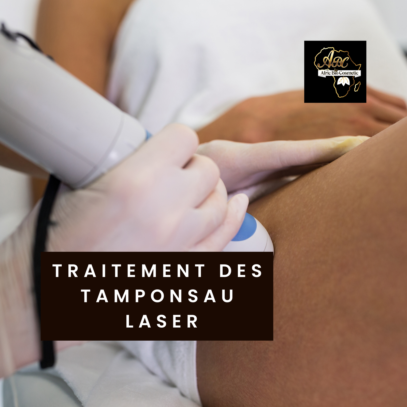 traitement des tamponsau laser